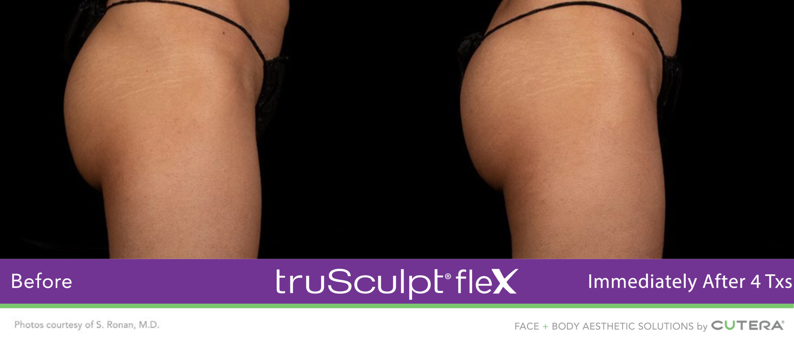 Trusculpt Flex – Before & After – Buttocks 1