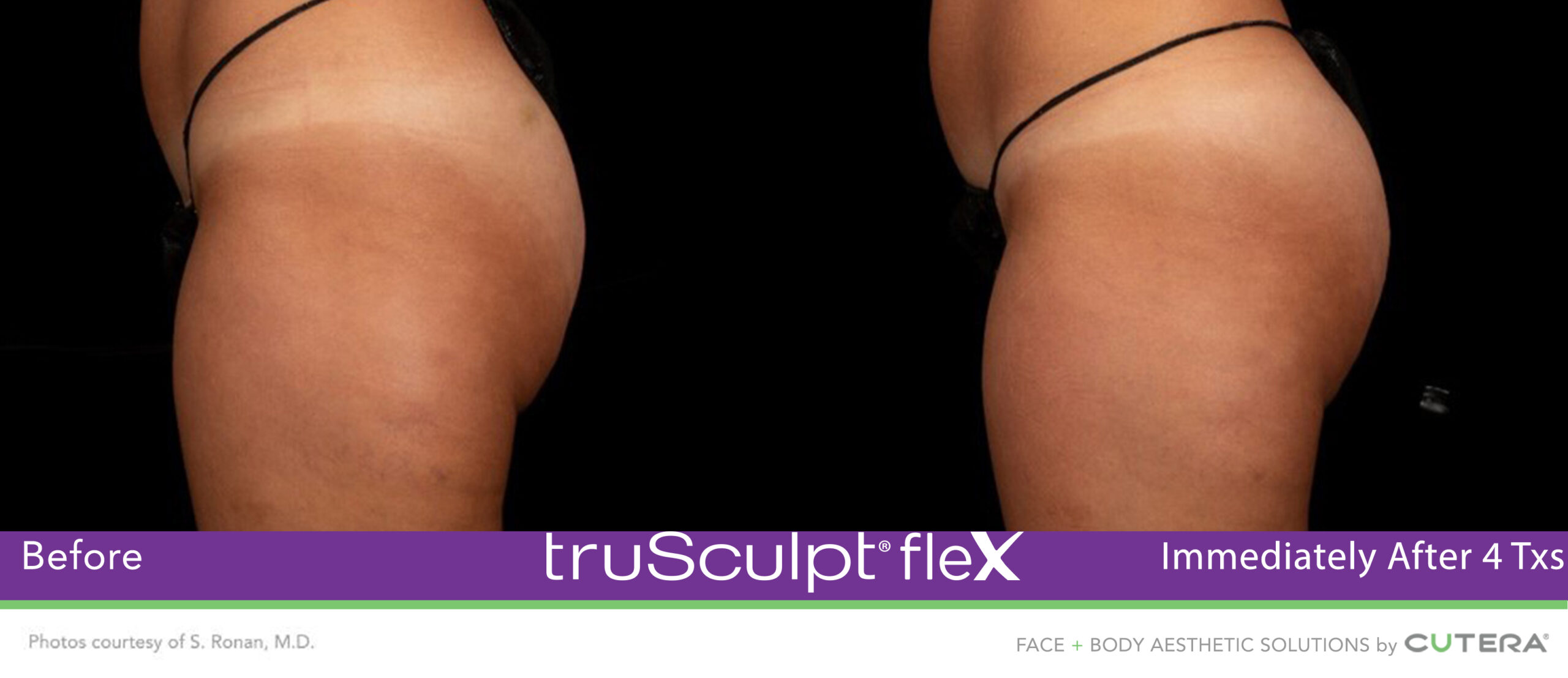Trusculpt Flex – Before & After – Buttocks 2