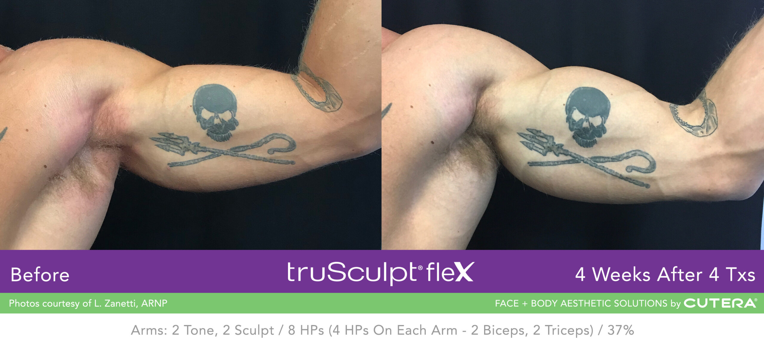Trusculpt Flex – Before & After – Arms 1