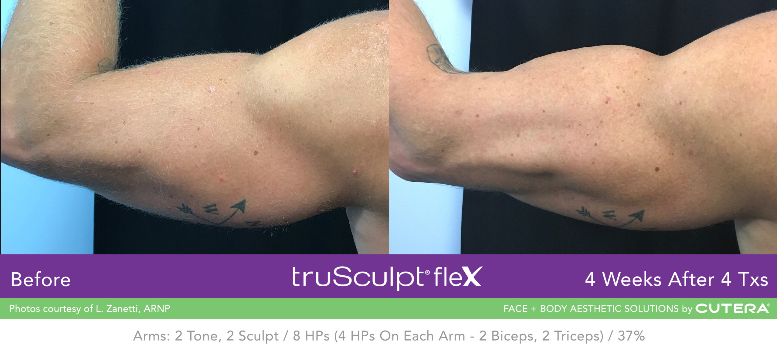 Trusculpt Flex – Before & After – Arms 2