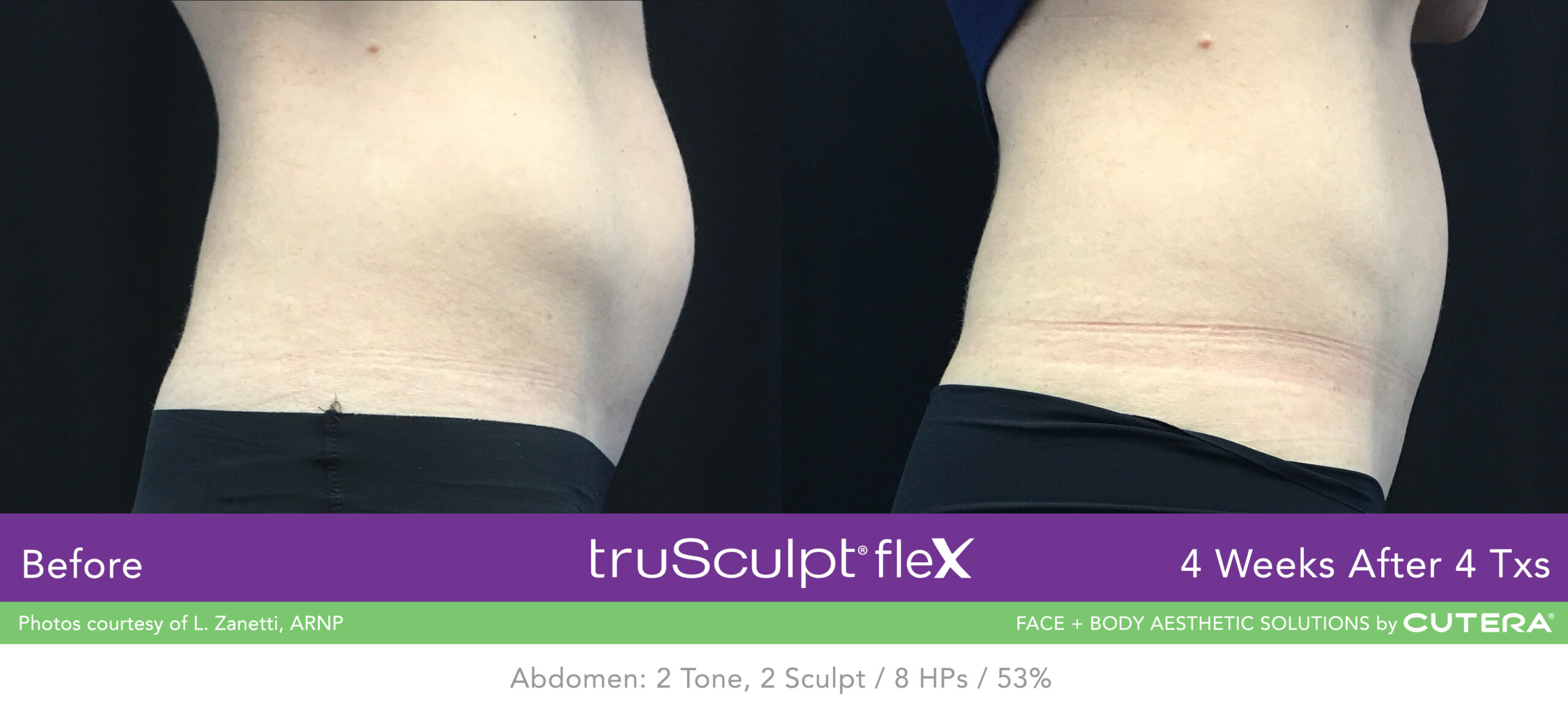 Trusculpt Flex – Before & After – Abdomen 7