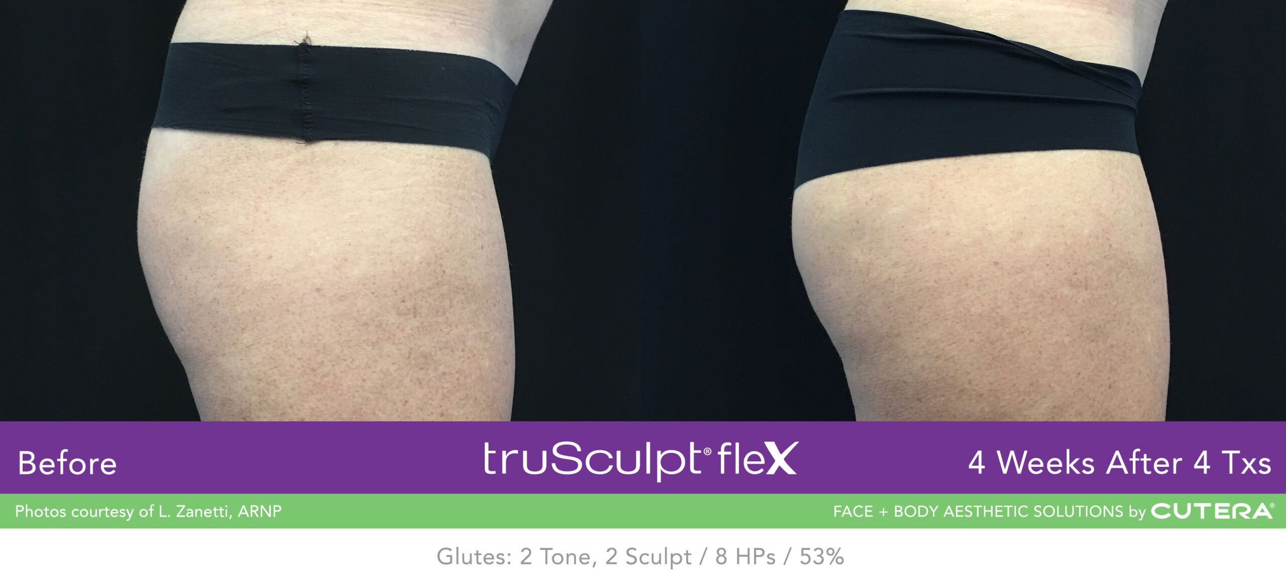 Trusculpt Flex – Before & After – Buttocks 4