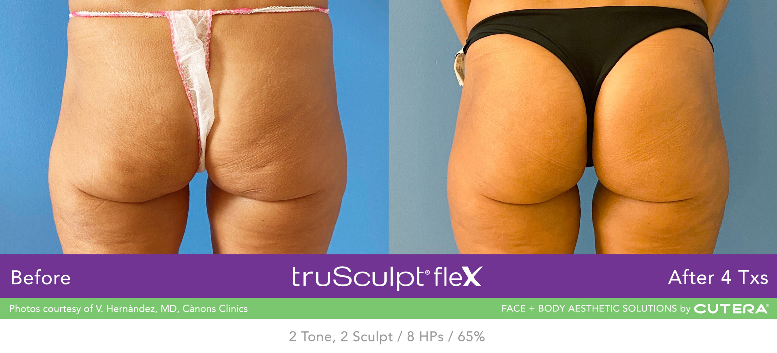 Trusculpt Flex – Before & After – Buttocks 5
